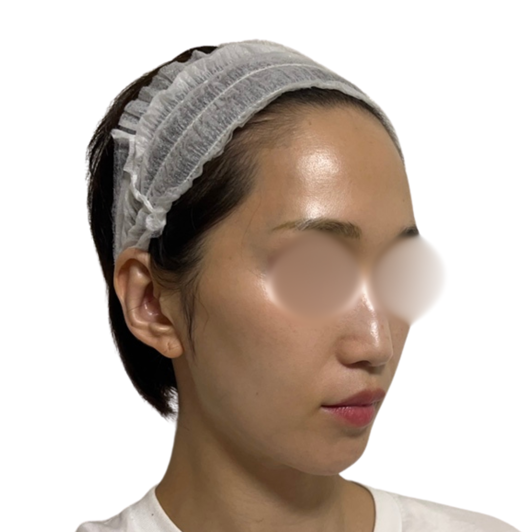 ピコフォーカス（ピコトーニング＋ピコフラクショナル）